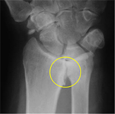 X-ray showing arthritis of the Distal Radioulnar Joint (DRUJ) of the wrist as evidenced by joint space narrowing and bone spurs (highlighted in yellow circle).